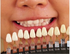 歯のセルフホワイトニングの効果